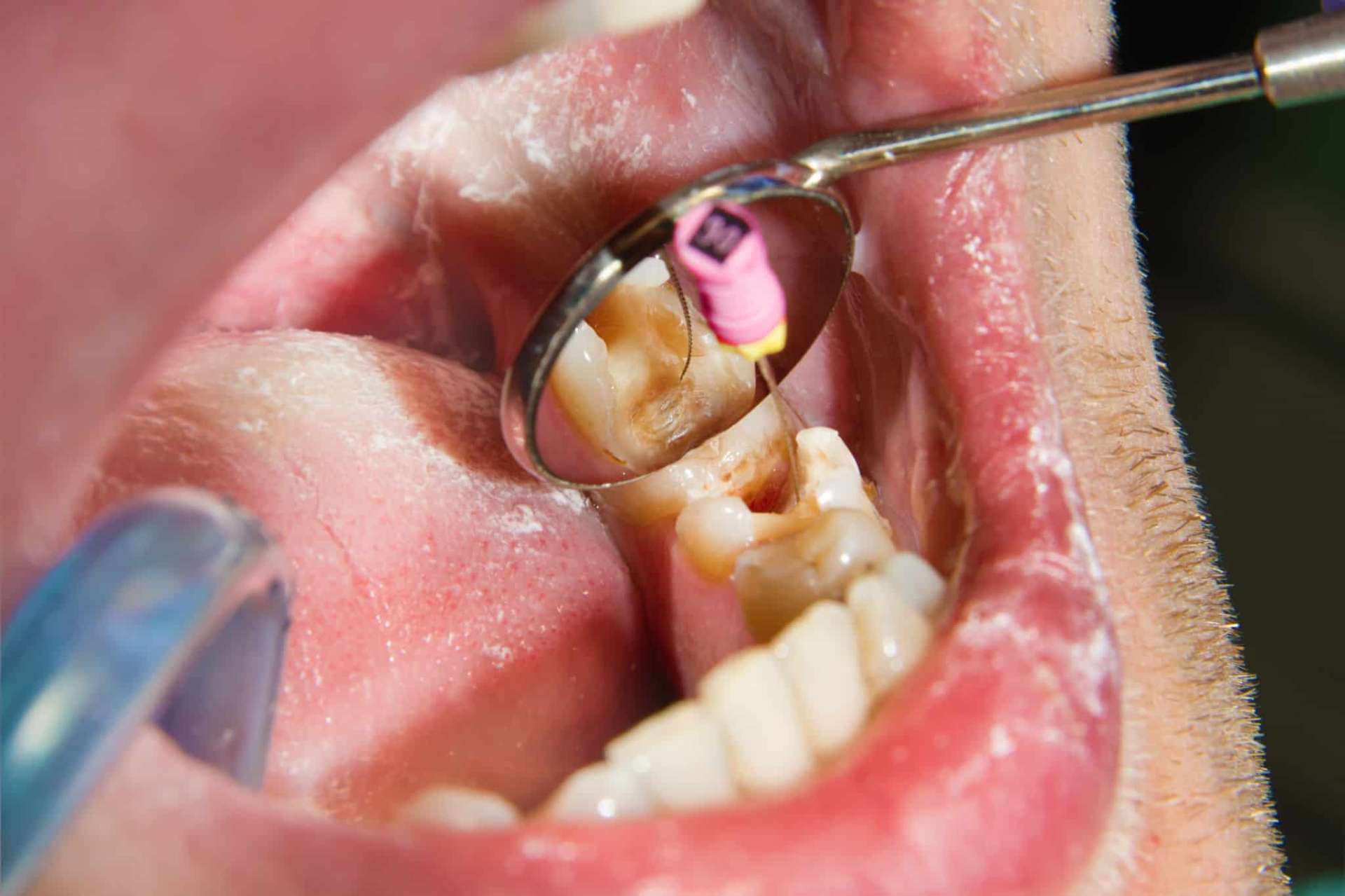 Root Canal Therapy